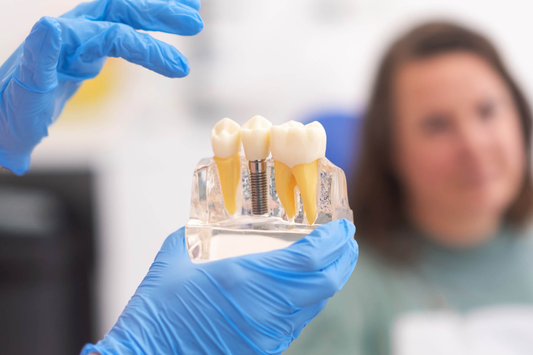 Dental Implant Procedure: Everything You Need to Know